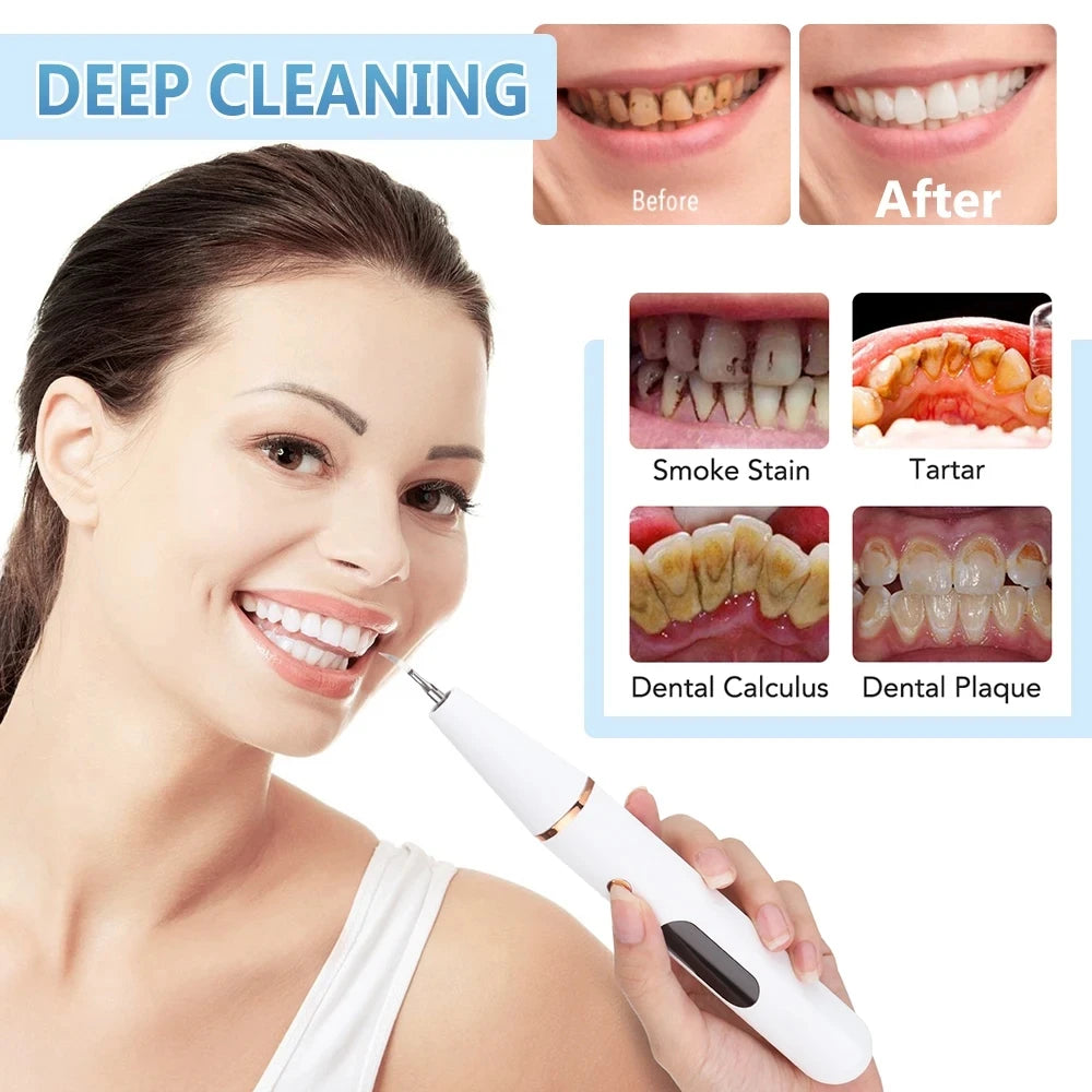 GLOWÉA Ultrasonic Dental Tartar Remover & Teeth Whitener GLOWÉA