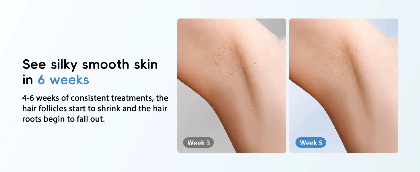GLOWÉA IPL Laser Epilator for Hair Removal - Painless Home Device GLOWÉA