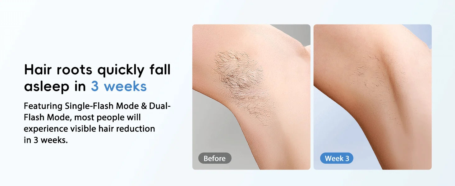 GLOWÉA IPL Laser Epilator for Hair Removal - Painless Home Device GLOWÉA
