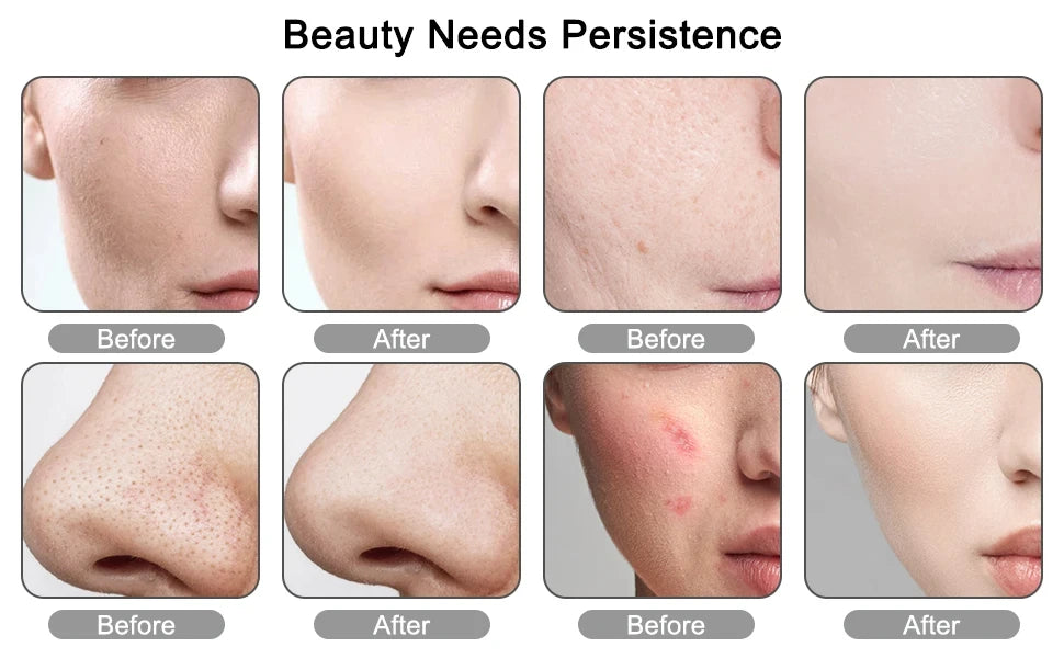 GLOWÉA Electric Blackhead Remover Vacuum Cleaner - GLOWÉA