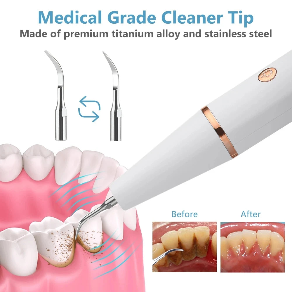 GLOWÉA Ultrasonic Dental Tartar Remover & Teeth Whitener GLOWÉA