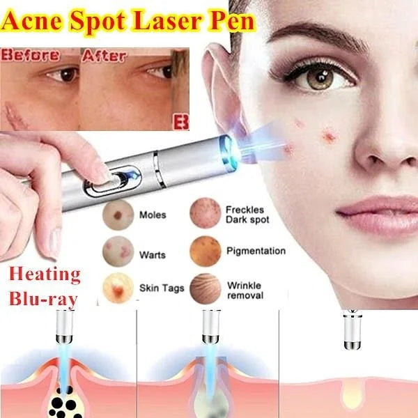Stylo laser portable contre l'acné GLOWÉA - Appareil de luminothérapie bleue