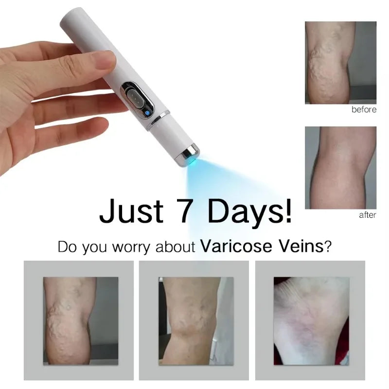 Stylo de réparation des varices par luminothérapie bleue GLOWÉA