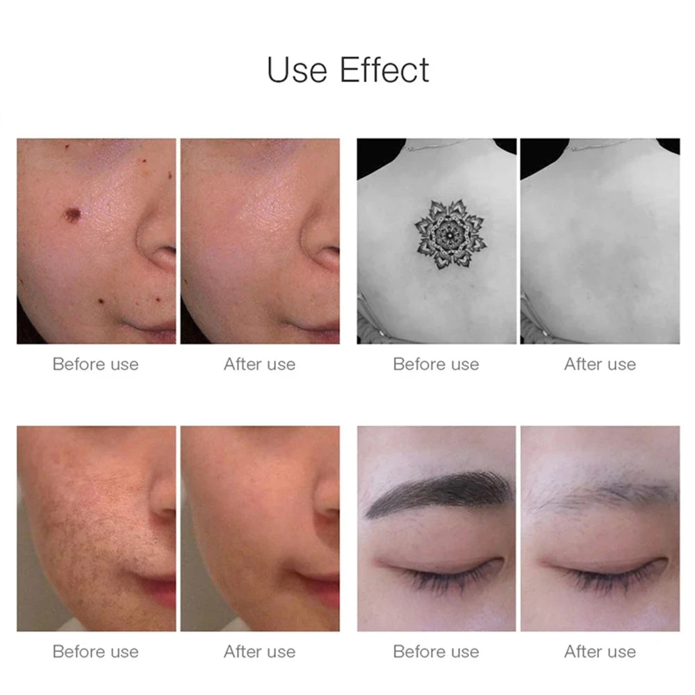 Stylo laser picoseconde GLOWÉA pour l'élimination des tatouages ​​et des cicatrices
